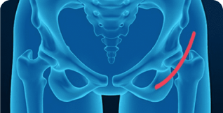 Direct Anterior Approach to hip replacement surgery Image