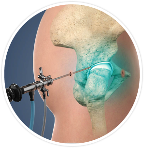 Procedure Process of Hip Joint Arthroscopy