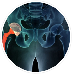 Bikini Hip Replacement,