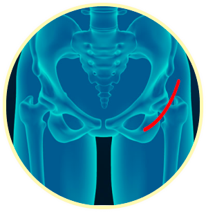Hip Fractures Image