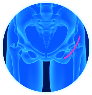 Implant Wear and Tear Image