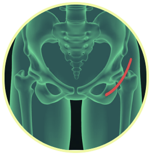 Hip Surgery Mechanical Failure Image
