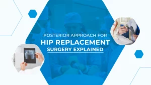 Posterior Approach for Hip Replacement Surgery Explained