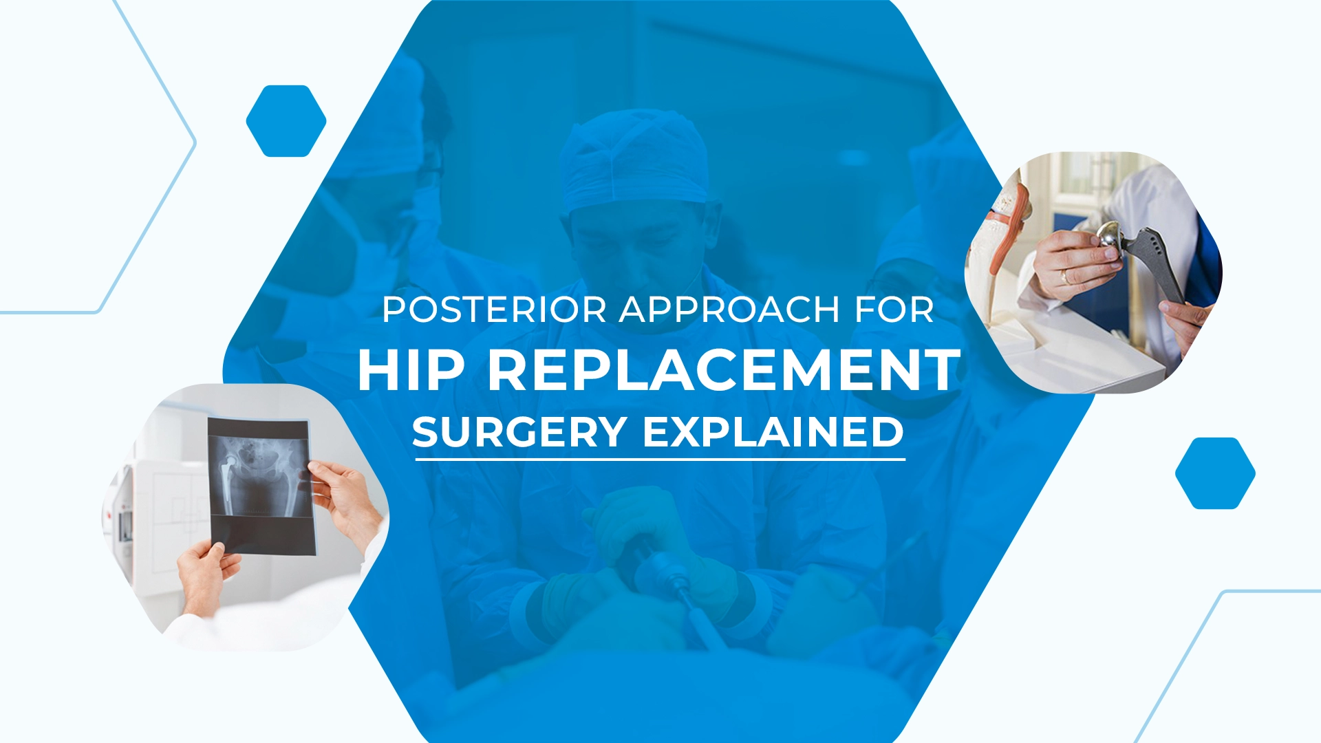 Posterior Approach for Hip Replacement Surgery Explained
