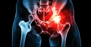 hip replacement in indore