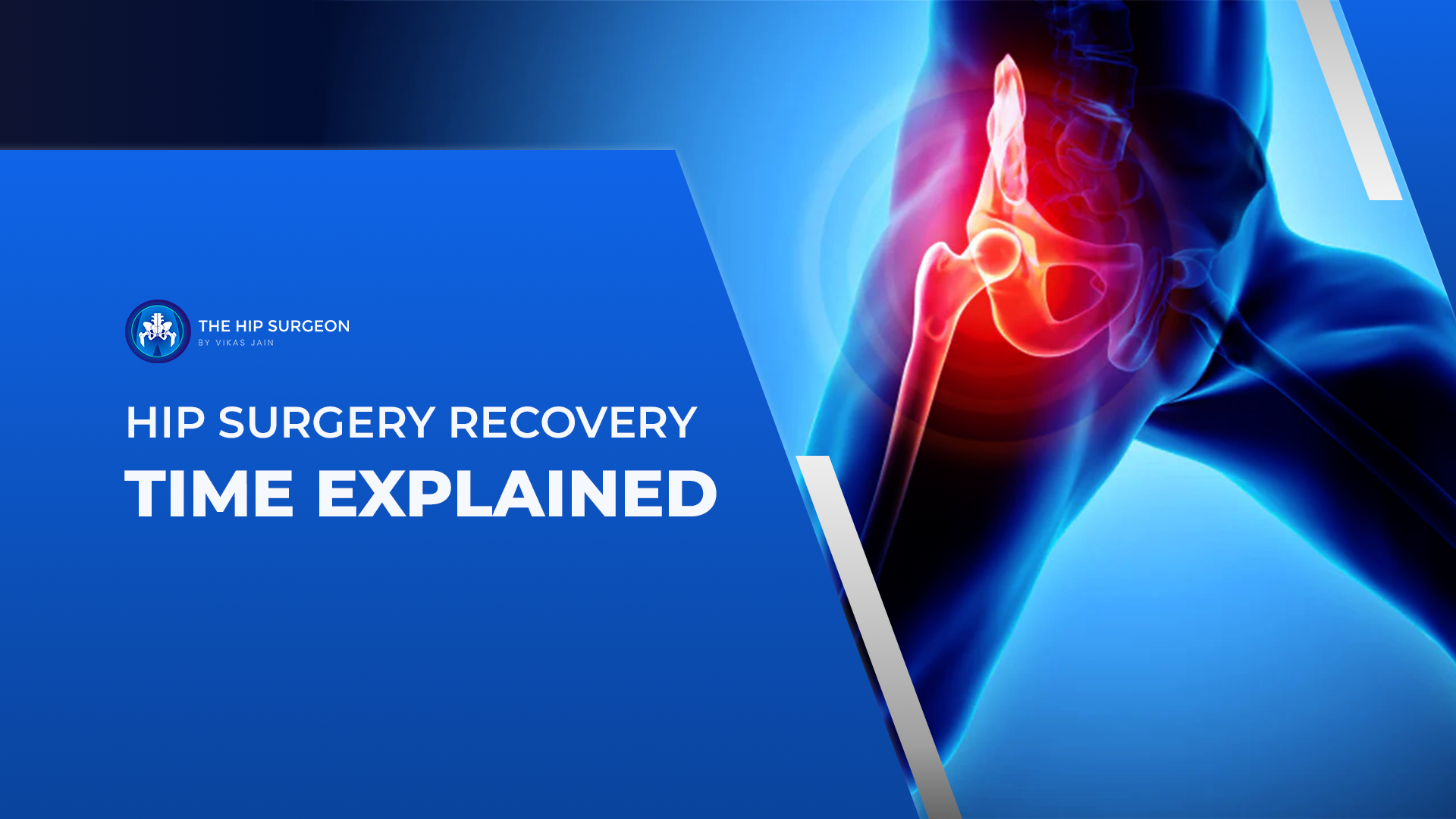 Hip Surgery Recovery Time Explained