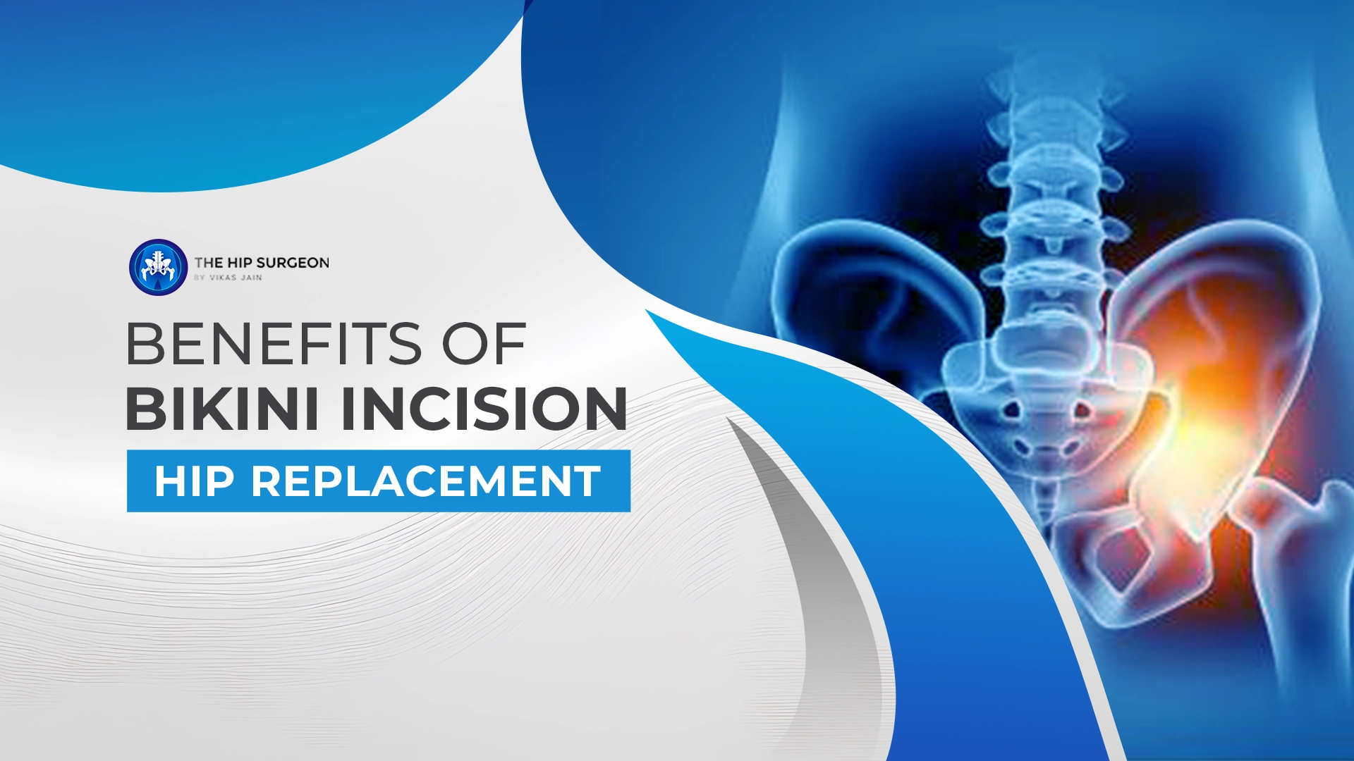 Benefits of Bikini Incision Hip Replacement
